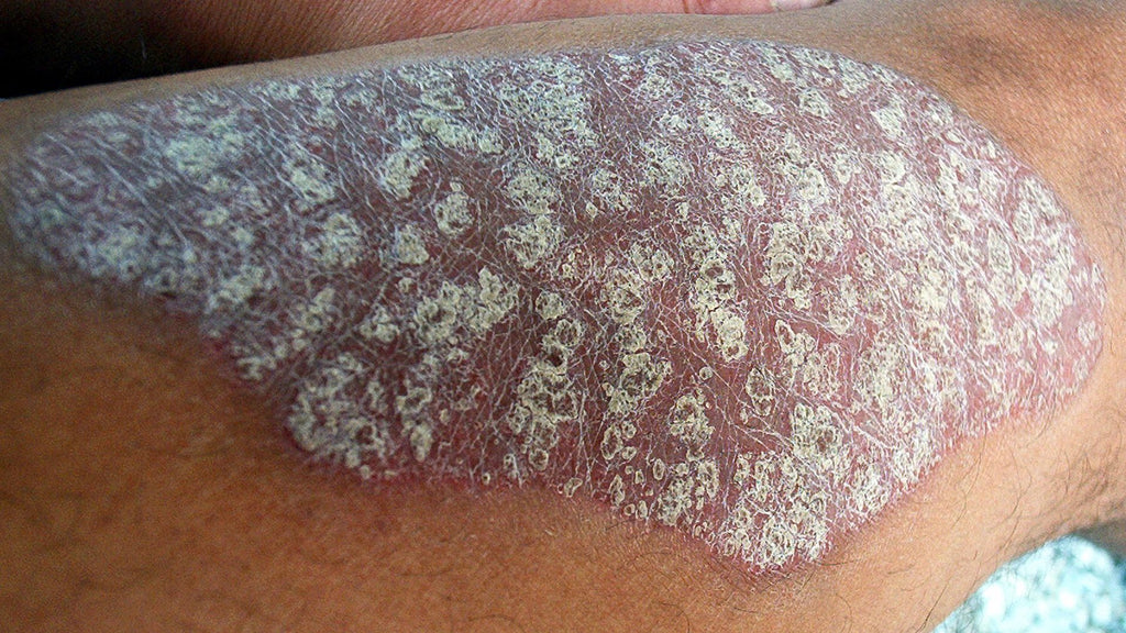 Psoriasis causes dead skin cells to build up rapidly on the surface of the skin.