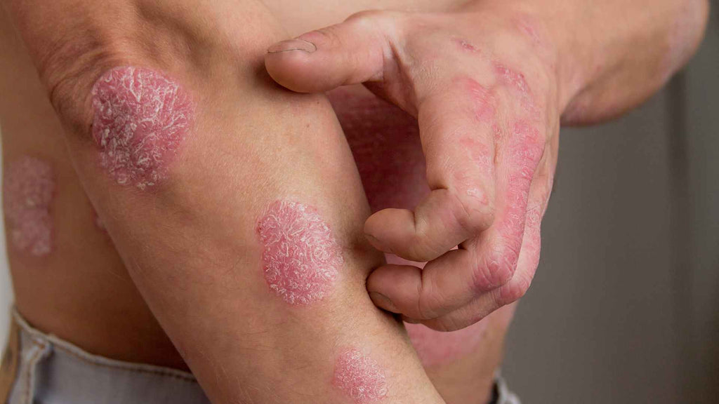 A person scratching their arm, which has multiple patches of red, flaky skin indicating psoriasis.