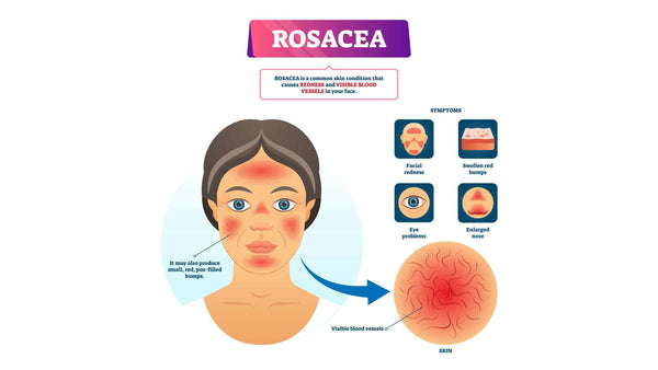 Síntomas de la infografía de rosácea