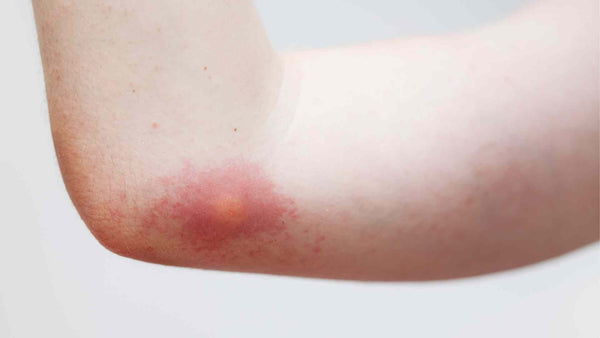 Wasp Sting: Reaction Symptoms, Treatments, and Remedies