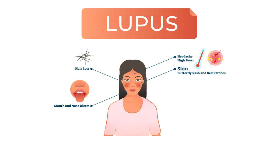 Symptoms of Lupus