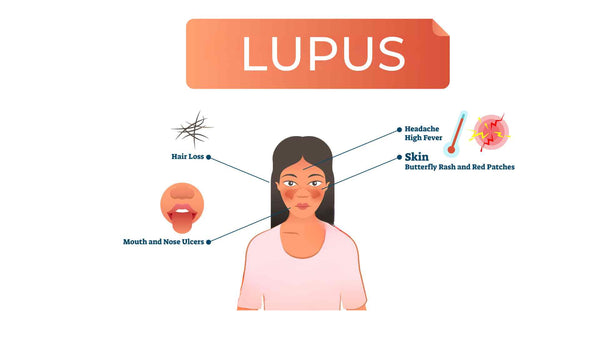 Síntomas del lupus