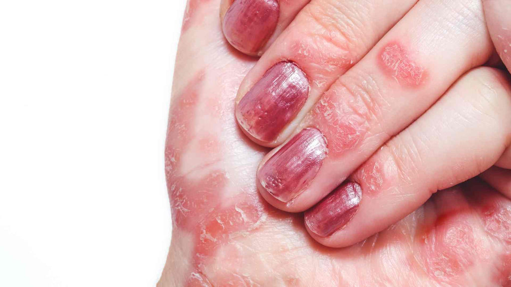 Psoriasis of the hand