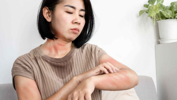 A woman sitting on a couch with a stress rash on her arm.