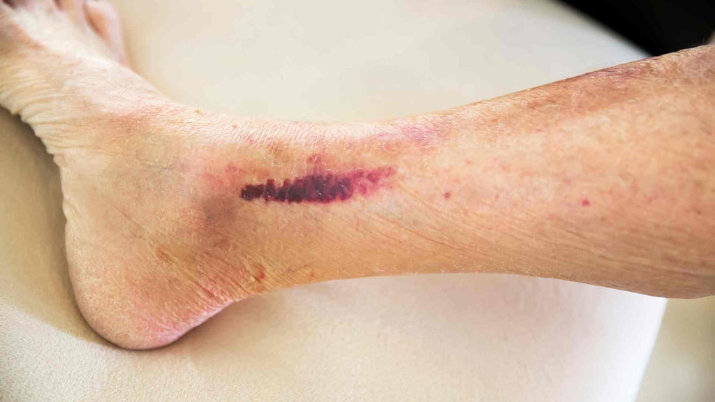 Easy bruising is a side effect of prolonged topical steroid use.