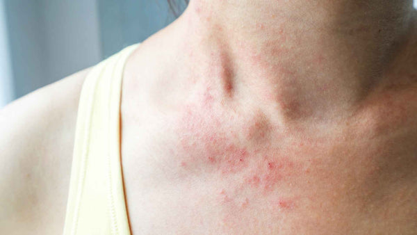 A woman with a rash on her neck.