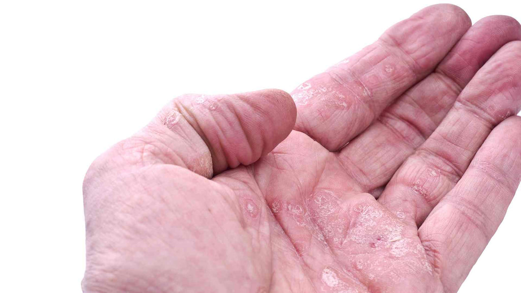 Contact dermatitis from an allergic reaction