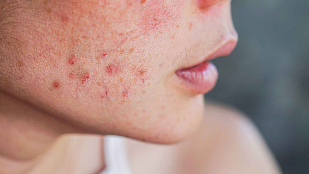 Acne caused by cortisol