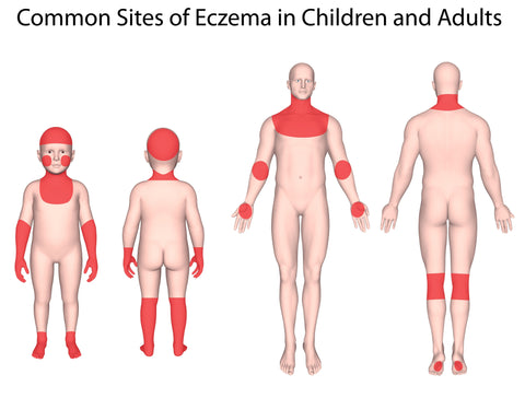 common_sites_of_eczema_children_adults