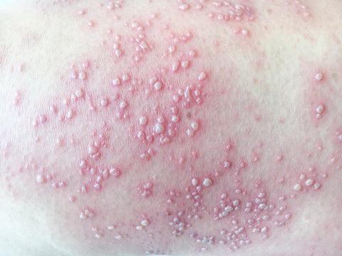 severe_back_shingles_herpes_zoster