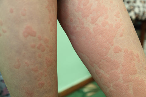 allergic_hives_legs