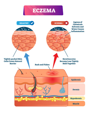 eczema_in_skin_diagram_atopic_dermatitis_dermeleve_can_help_soothe