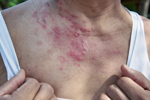 herpes_zoster_shingles_on_woman_breast