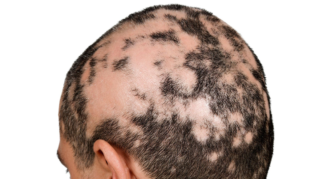 Alopecia