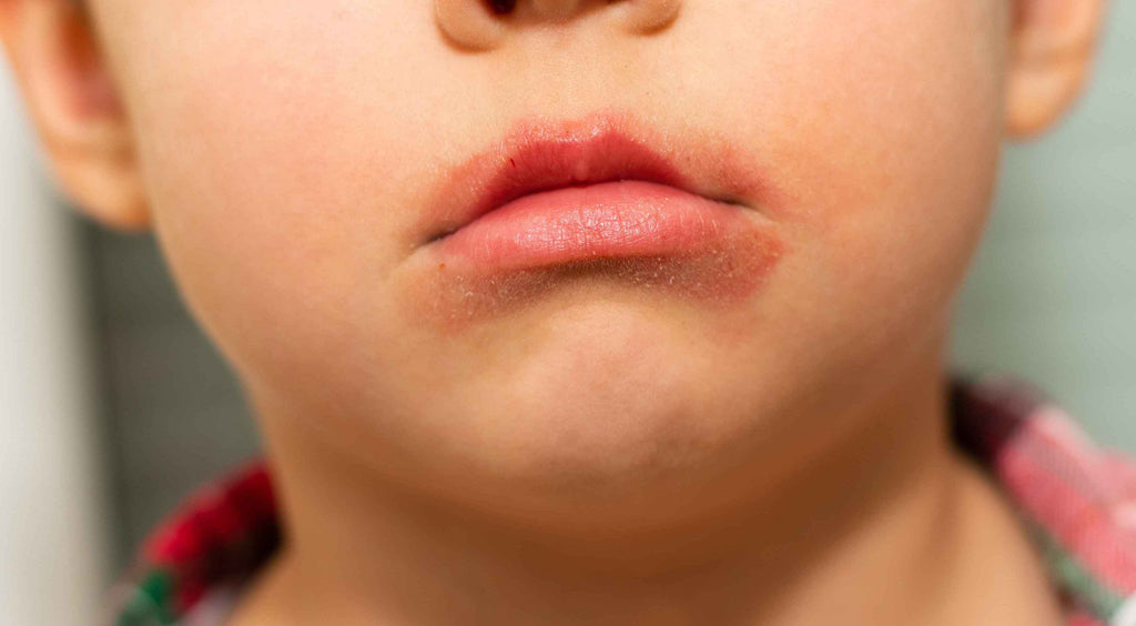 Child With Lip Licker Dermatitis