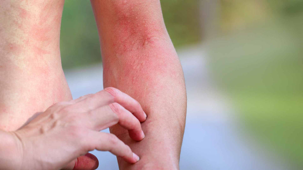 Close-up of a person scratching their inflamed and reddened skin on their arm.