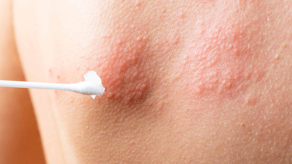 Petroleum jelly can help relieve the discomfort of a chlorine rash.
