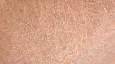 Dry skin can causes itchy skin