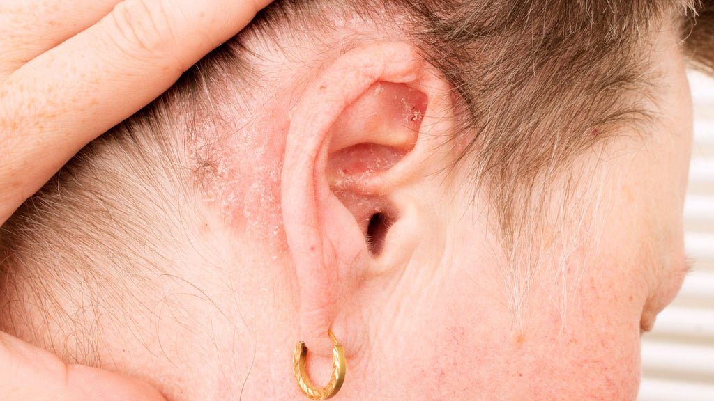 Ear psoriasis