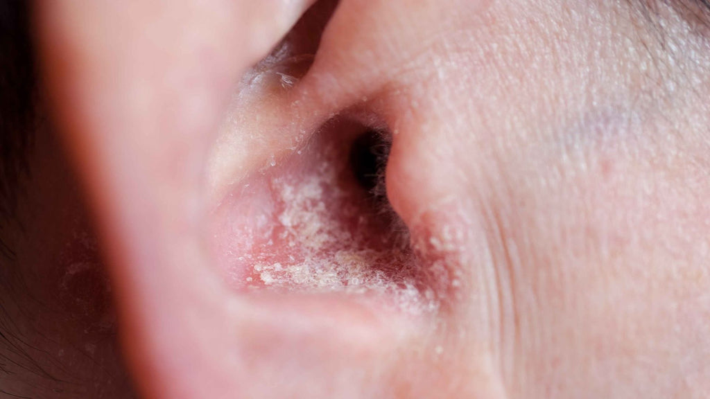 Ear psoriasis can cause blockages in the ears causing hearing loss