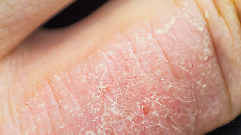 Closeup of eczema