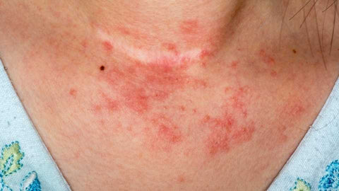 Eczema can causes itchy skin