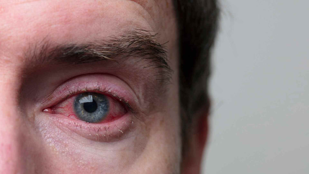 A close up of a man's eye with pink eye, exhibiting eye and eyelid itch.