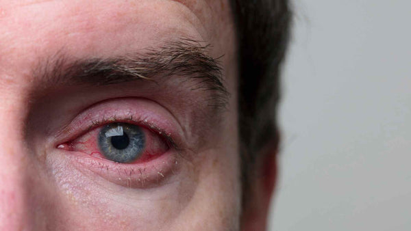 Un primer plano del ojo de un hombre con ojo rosado, exhibiendo ojos y picazón en el párpado.