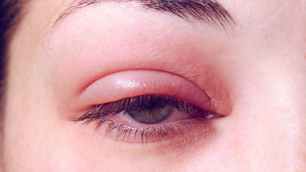 A close up of a woman's eye experiencing an infection causing eyelid itch.