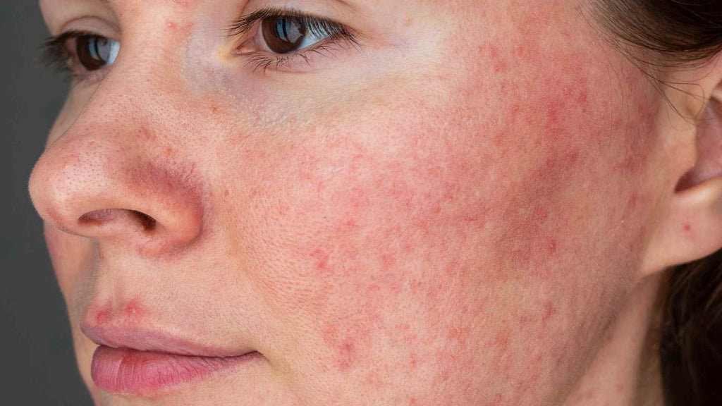 A close up of a woman with rosacea on her face experiencing eyelid itch.