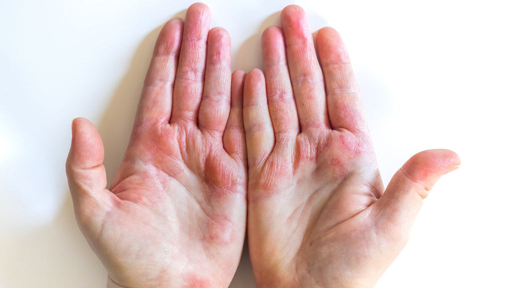 A person's hands with red skin, possibly indicating fiberglass rash.