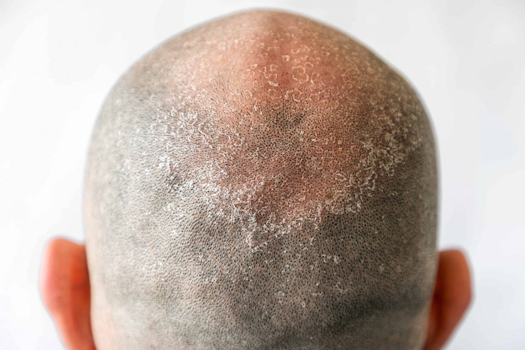 Flakey skin on the scalp from a sunburn