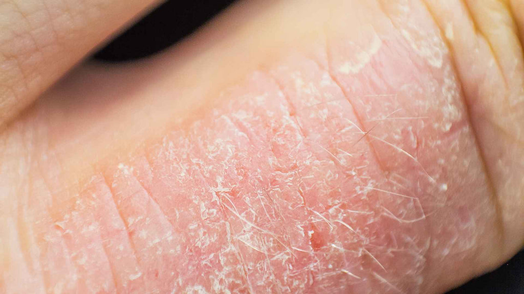 Skin with eczema