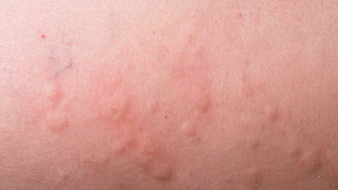 Hives on skin