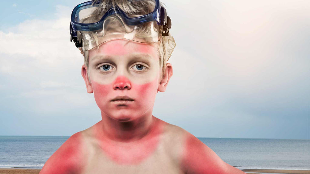 A young boy with a sunburn on his face and body.