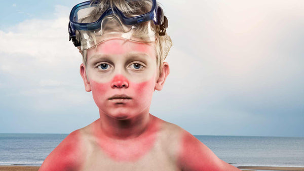 Un niño con una quema de sol en la cara y el cuerpo.