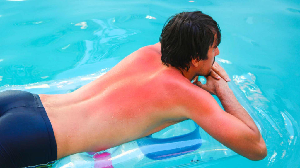 A man lying in a pool, with a sunburned back.