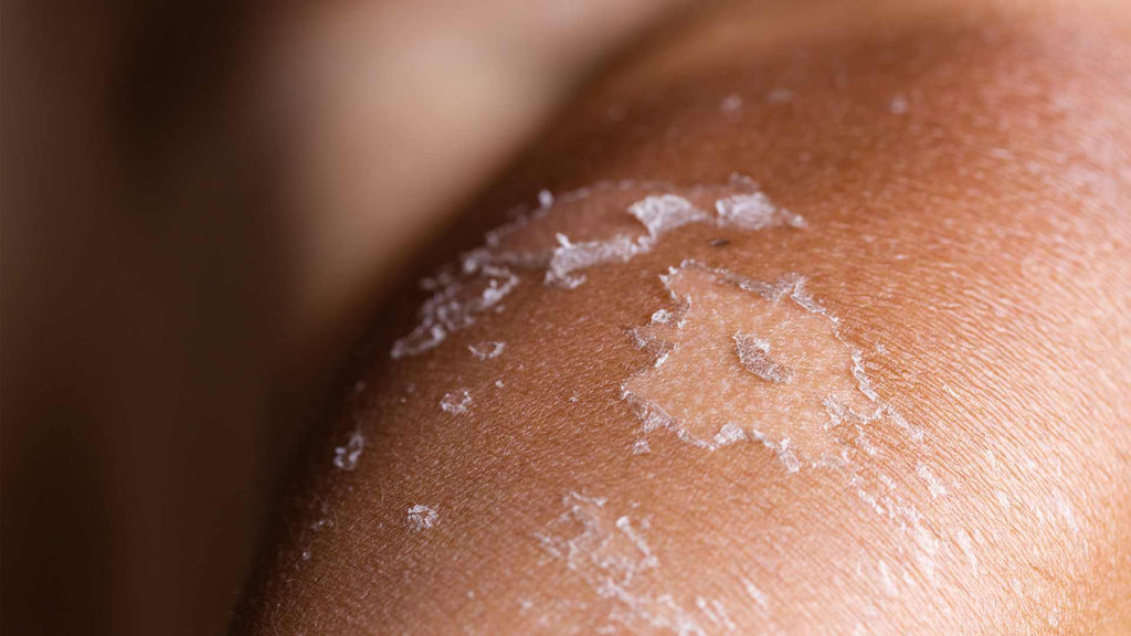 A close up of a person's arm with peeling skin from a sunburn.