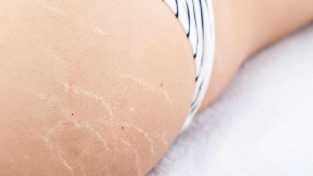 Extended hydrocortisone use can lead to stretch marks