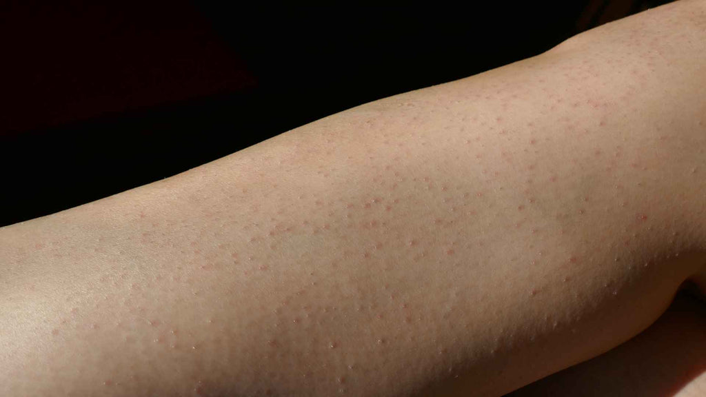 Bumps and Itching After Laser Hair Removal Treatment