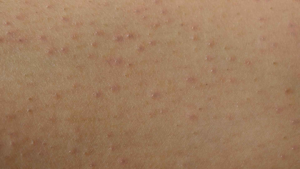 Irritation After Laser Hair Removal Treatment