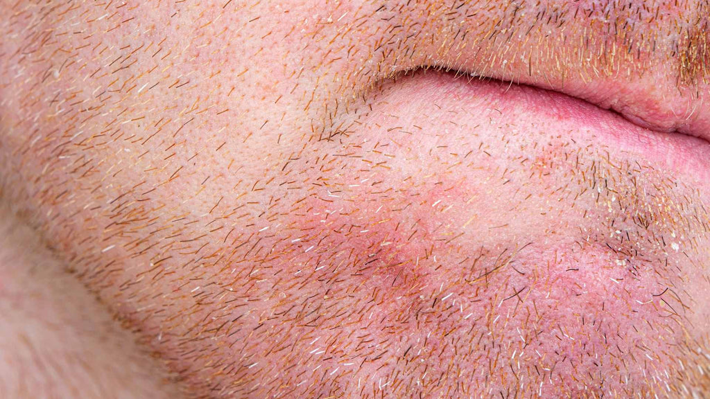 A man with eczema on his chin
