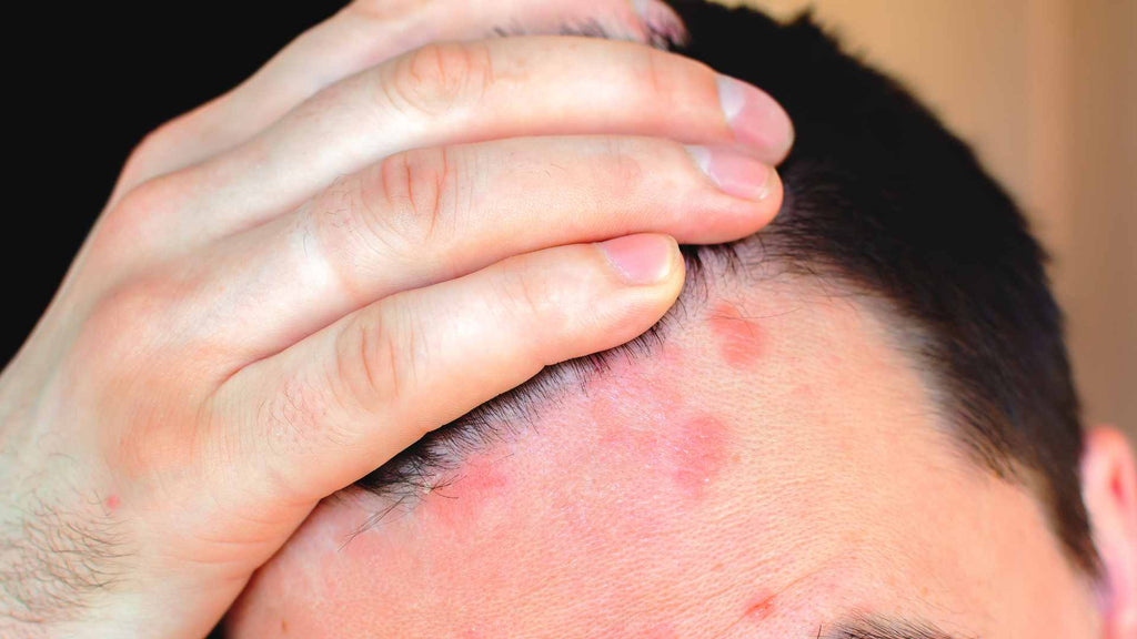 A man with psoriasis on his forehead