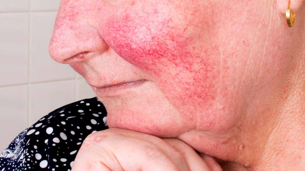 A woman with rosacea on her face