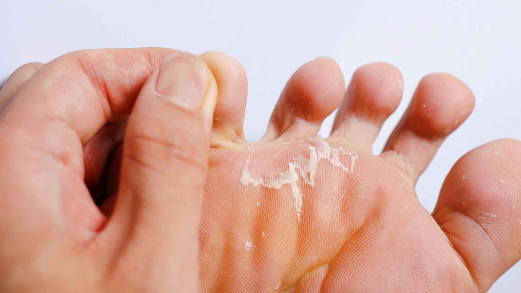 Athlete's foot can spread to the hands