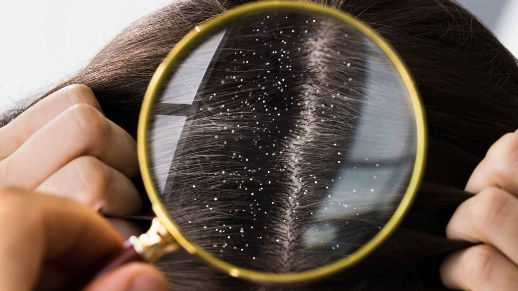 Close-up view of a person examining the scalp and hair through a magnifying glass, revealing dandruff.