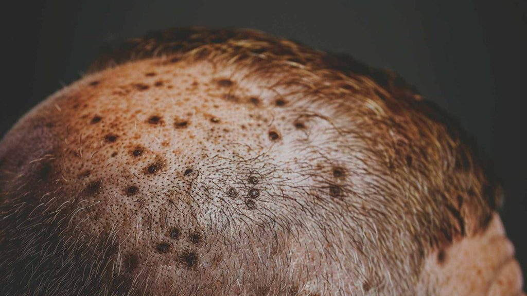 A close-up view of a person's scalp showing hair thinning and some freckles or moles.