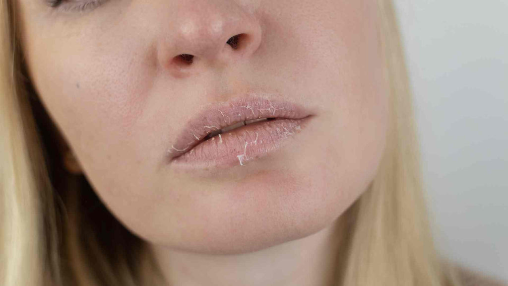 Woman with dry, cracked lips