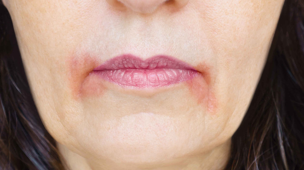Lip Licker's Dermatitis