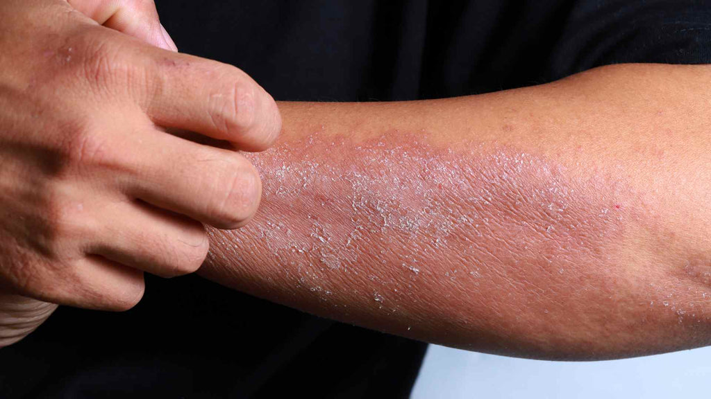 Dry itchy skin from a nickel allergy